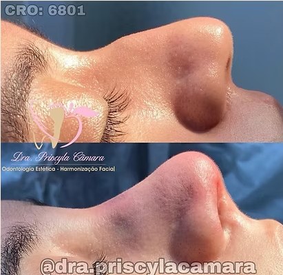 Antes e depois de rinomodelação estruturada, vista de perfil